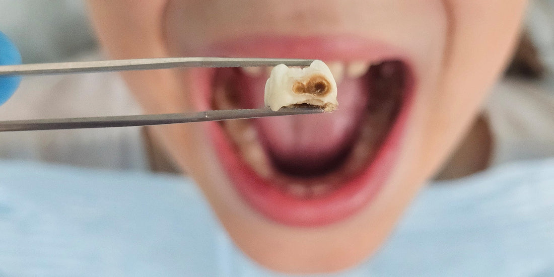 How to Prevent and Treat Tooth Decay at Home