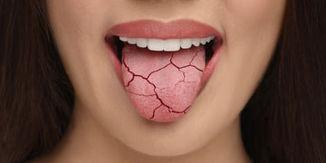 Dry Mouth: Causes, Symptoms, and Home Remedies
