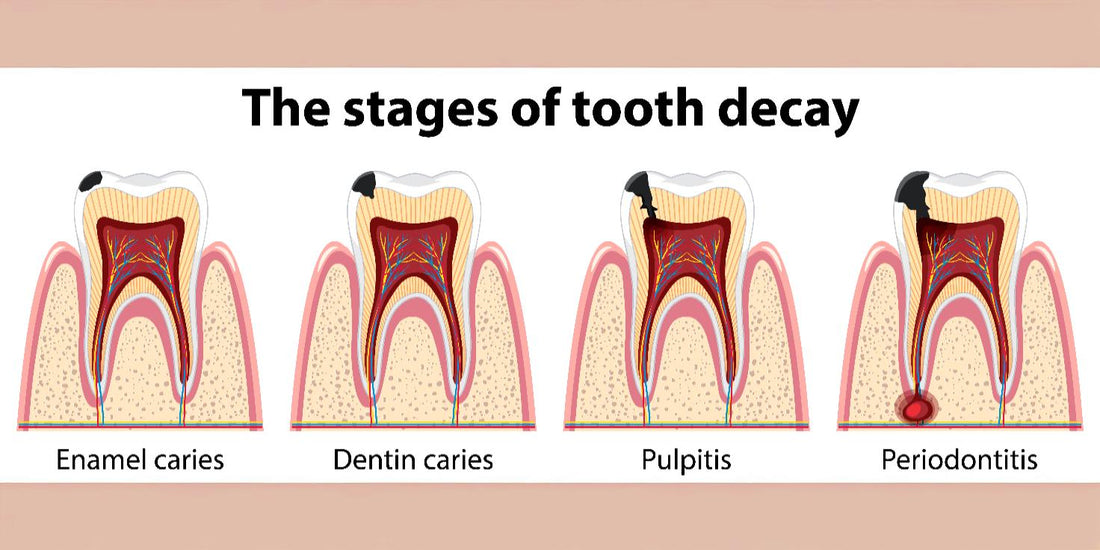 Cavities vs. Enamel Erosion: What’s the Difference?