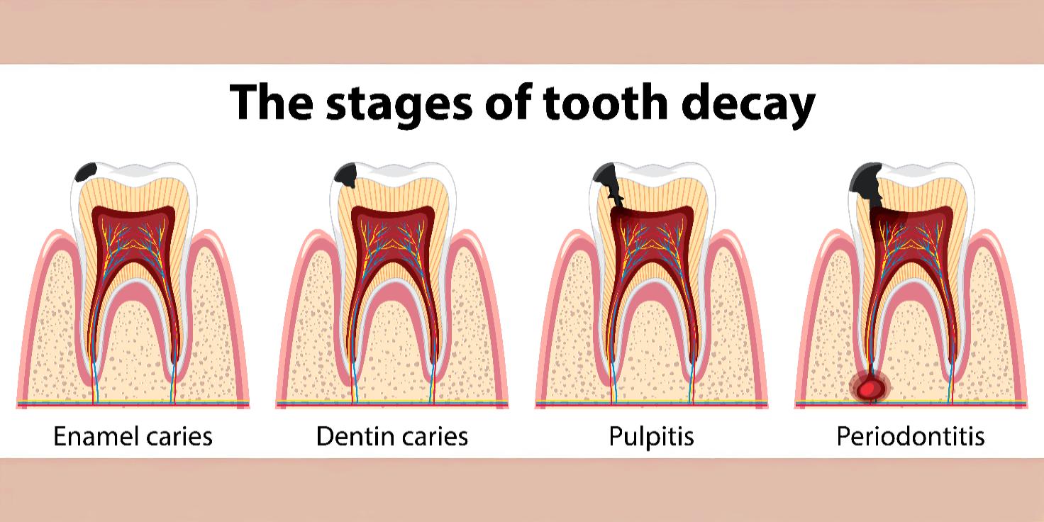 Cavities vs. Enamel Erosion: What’s the Difference?