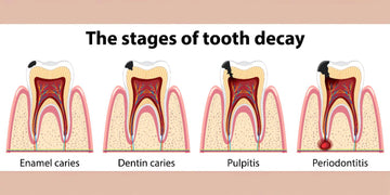 Cavities vs. Enamel Erosion: What’s the Difference?