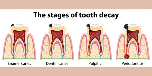 Cavities vs. Enamel Erosion: What’s the Difference?