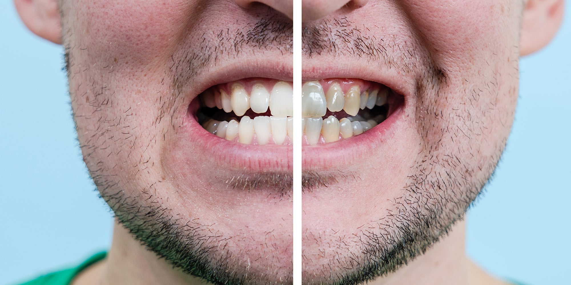 How to Remove Stains from Teeth: Dentist-Approved Tips