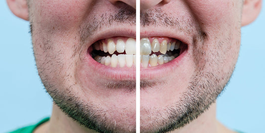 How to Remove Stains from Teeth: Dentist-Approved Tips