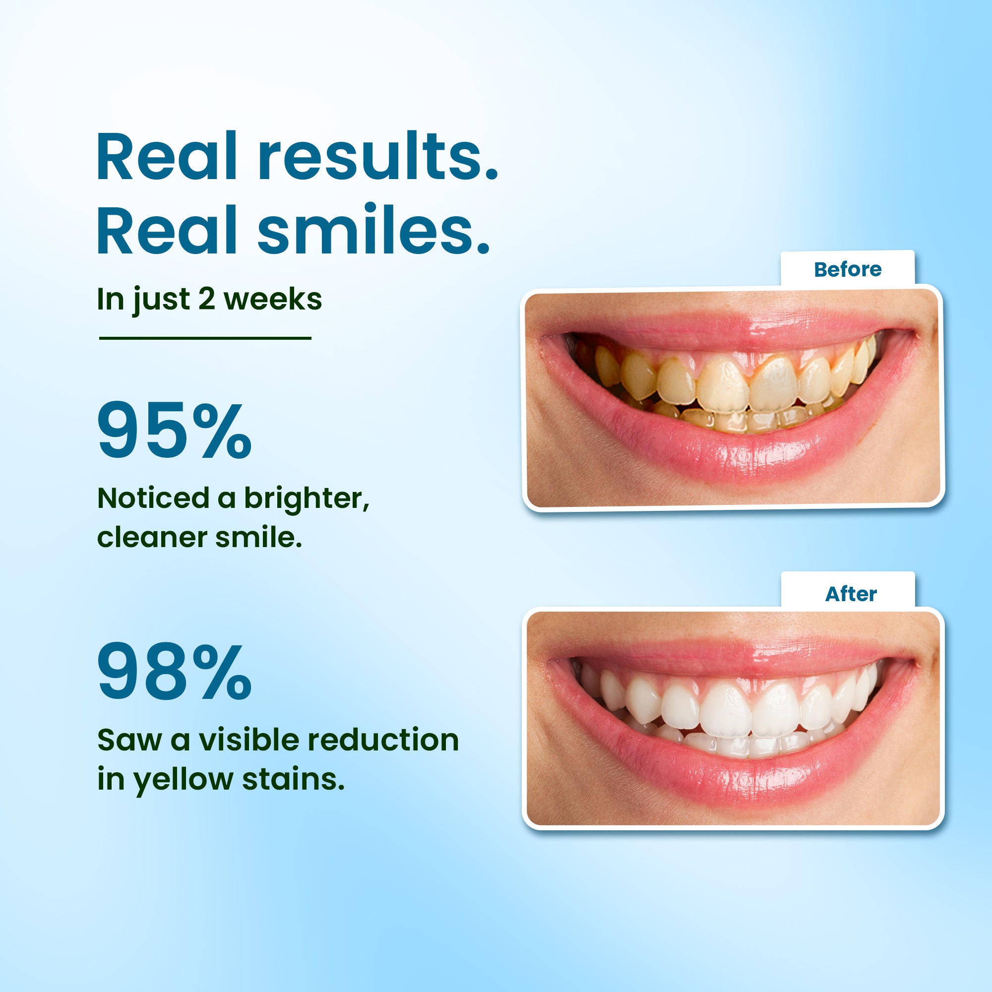 Hydroxyapatite, Whitening, Sensitivity